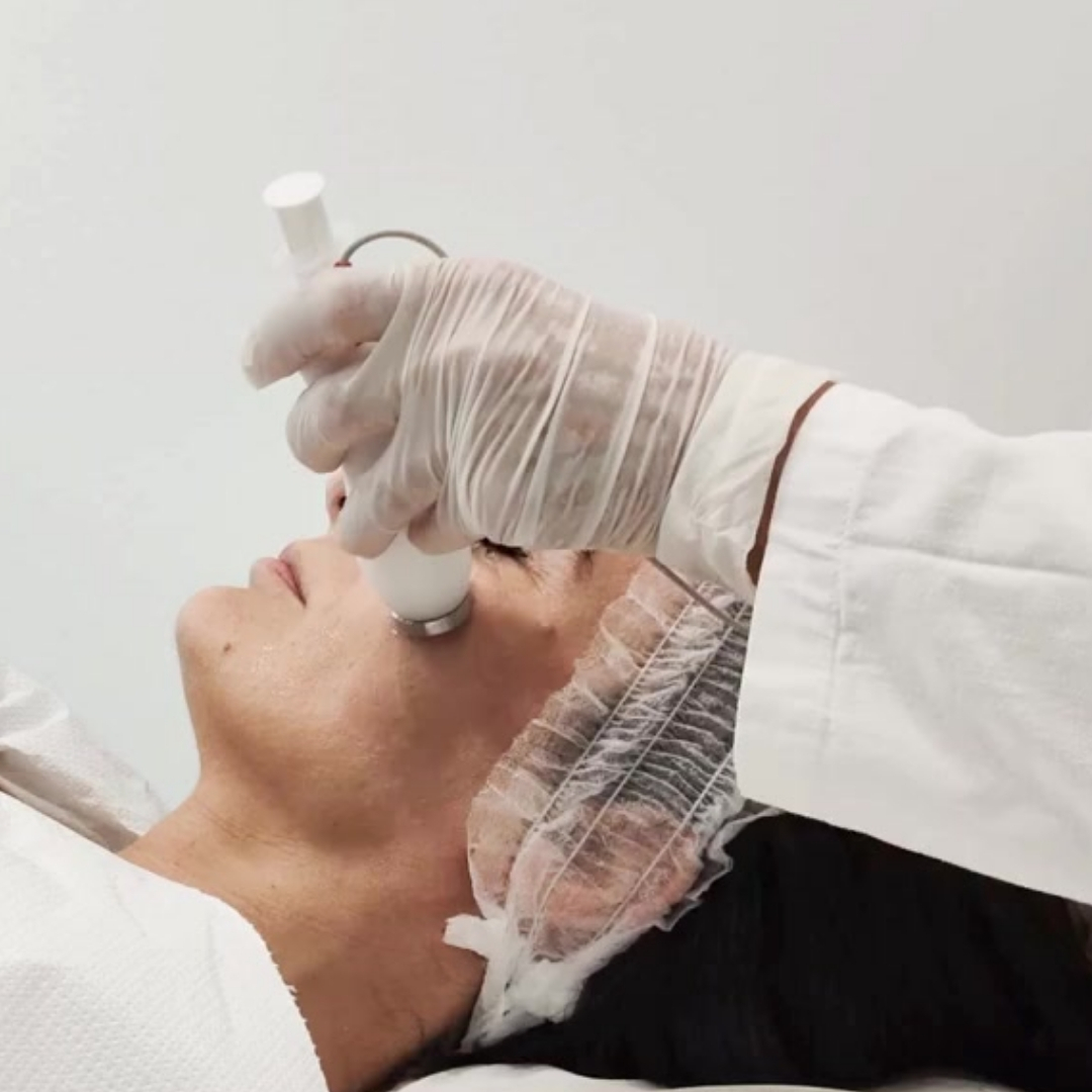 elettroporazione viso